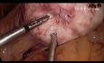 Laparoscopic Myomectomy HD Video for Multiple Myoma using Mishra's Knot