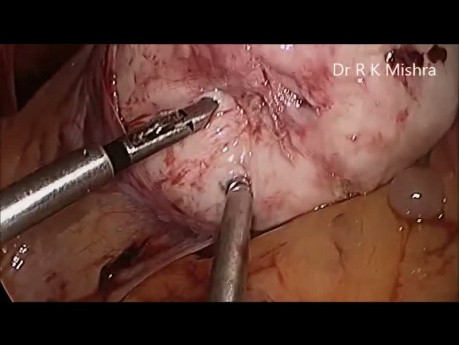 Laparoscopic Myomectomy HD Video for Multiple Myoma using Mishra's Knot