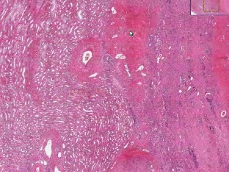 Wilms tumor - Histopathology - Kidney