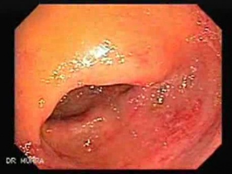 Invasive amebiasis and ameboma formation (3 of 4)
