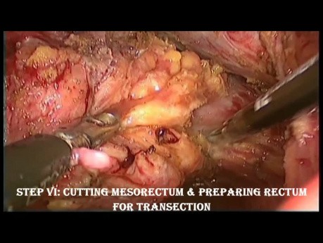 Laparoscopic Low Anterior Resection