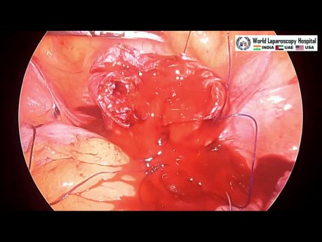 Laparoscopic Myomectomy Lateral Wall Fibroid Uterus