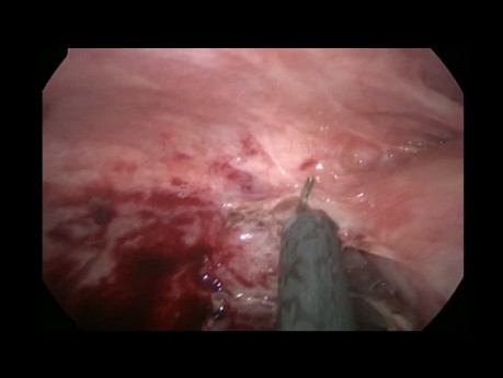 Minimally Invasive Management of Gangrenous Appendicitis with Generalized Peritonitis and Pelvic Abscess