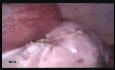 18 wks Pregnancy with Large Ovarian Cyst Operated with Laparoscopy