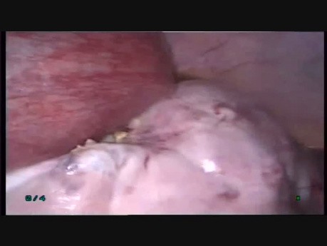 18 wks Pregnancy with Large Ovarian Cyst Operated with Laparoscopy