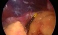 Laparoscopic gastric banding