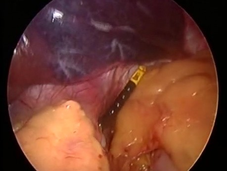 Laparoscopic gastric banding
