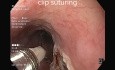 Esophageal SMT Resection