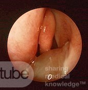 Left Antro-Choanal Polyp