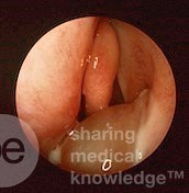 Left Antro-Choanal Polyp