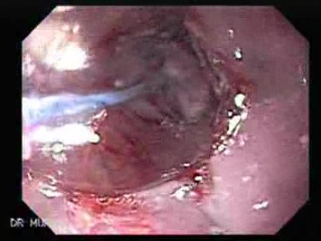Endoscopic Baloon Dilation Of The Esophageal Stricture - Position Of The Inflated Baloon - 8/8