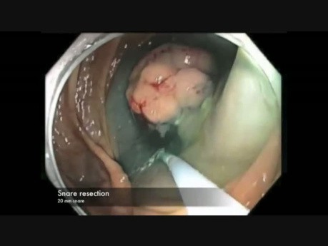 Cecum-EMR Bleed-Position Change-B