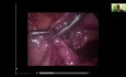 Laparoscopic Tubal Milking for Distal Ectopic Pregnancy