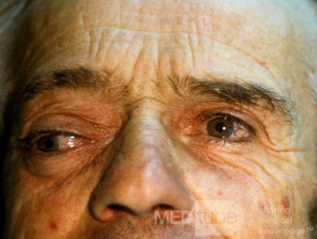Frontoethmoidal Mucocele with Intraorbital Expansion