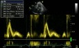 Restrictive Filling Pattern Mitral Inflow