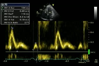 Restrictive Filling Pattern Mitral Inflow