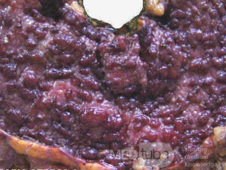 Multiple Rectal Ulcers (101 of 110)