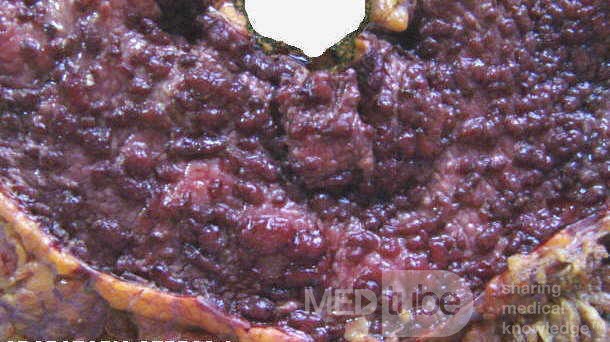 Multiple Rectal Ulcers (101 of 110)