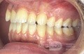 Orthodontic Case, What Treatment Plan?