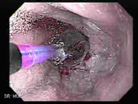 Endoscopic Baloon Dilation Of The Esophageal Stricture - Fast-Forward Video