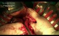 Surgery for gastrointestinal tumor (GIST) of the stomach