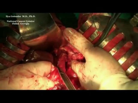 Surgery for gastrointestinal tumor (GIST) of the stomach