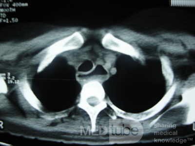 Esophagus - Pneumatic Dilation for Achalasia (31 of 31)