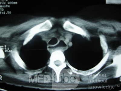 Esophagus - Pneumatic Dilation for Achalasia (31 of 31)