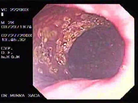 Familial Adenomatous Polyposis of the Colon (25 of 29)