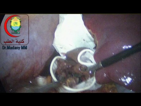 Home Made Retieval Bag Can Be Used to Retrieve The Cyst Wall And Debris In Case of Huge Liver Cyst