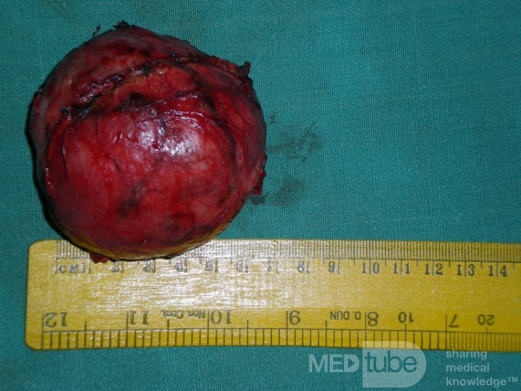 Retroperitoneal Mass