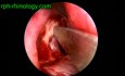 Dacrocystorhinostomy- Endoscopic View