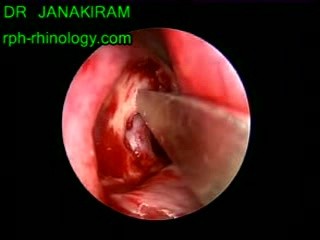 Dacrocystorhinostomy- Endoscopic View