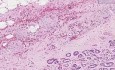 Prostate - Adenocarcinoma (Gleason grade 3) - Histopathology