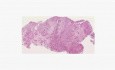 Mesothelioma - Histopathology - Lung, pleura