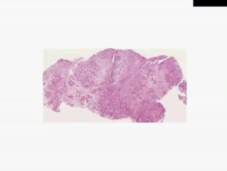 Mesothelioma - Histopathology - Lung, pleura