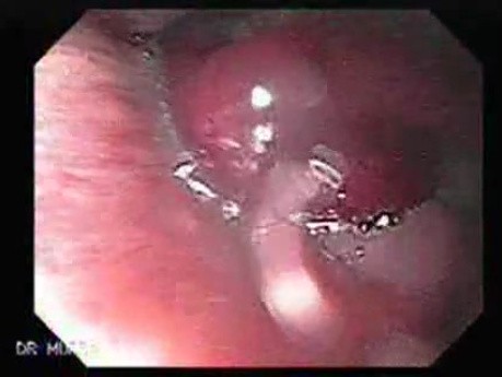 Hemangioma of the larynx