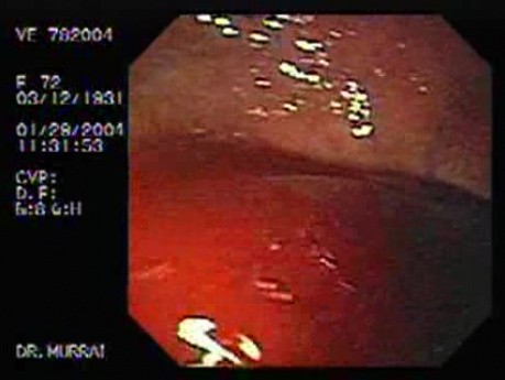 Mallory-Weiss Syndrome - Dark Blood in the Fundus