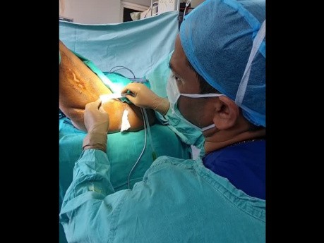  Anal Fistula Treatment Ano-Popliteal Fistula "Longest Anal Fistula"