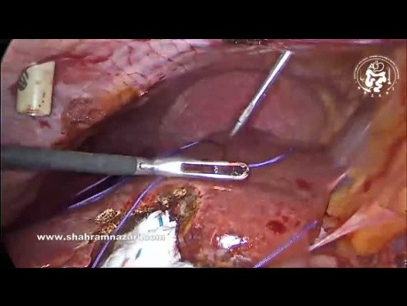 Laparoscopic Port Closure Techniques