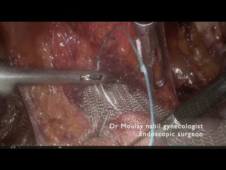 Pectopexy  for Genitourinary Prolapse in case of Obese Patient