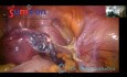 Fastest and Safest Laparoscopic Hysterectomy