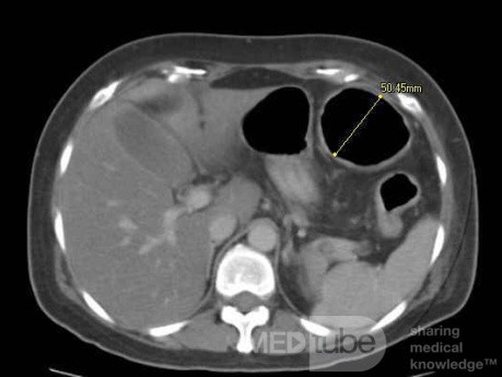Multiple Rectal Ulcers (39 of 110)