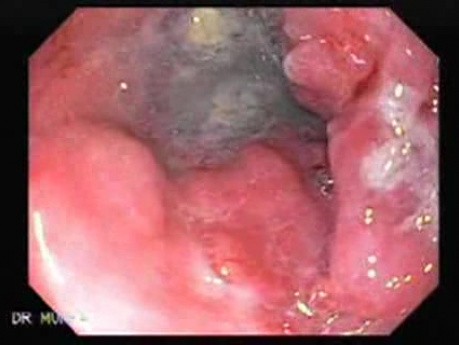 Barrett Adenocarcinoma (1 of 4)