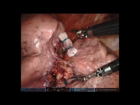 Unedited Robotic Left Upper Lobectomy to Manage Synchronous Bilateral Lung Primary Tumours