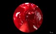 Endoscopic Transnasal Approach for Resection of Pituitary Microadenoma in Acromegaly Patient 