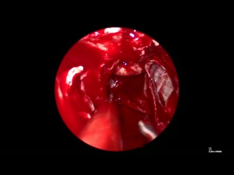 Endoscopic Transnasal Approach for Resection of Pituitary Microadenoma in Acromegaly Patient 