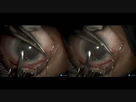 Buphthalmos Failed Surgery - Reverse Cyclodialysis
