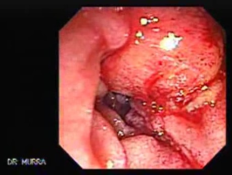Adenocarcinoma of Papilla of Vater (2 of 5)
