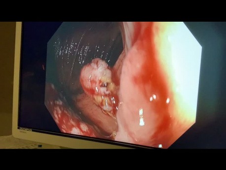 EMR 5 cm Seesile Colon Polyp